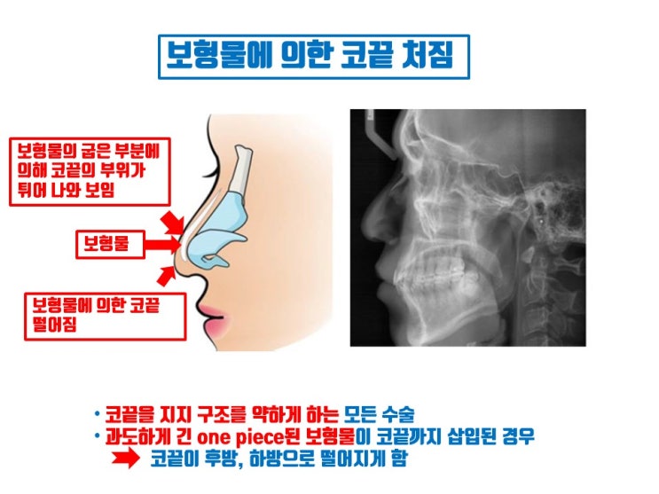  코끝 처짐, 코끝까지 삽입한 코성형 보형물의 또 다른 부작용이랍니다.