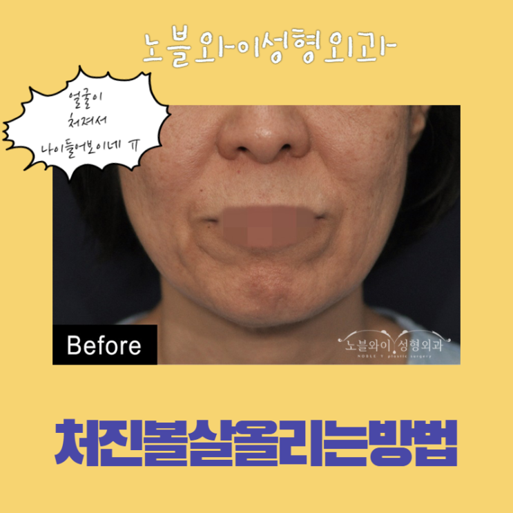  처진볼살올리는방법 시술로도 안된다면