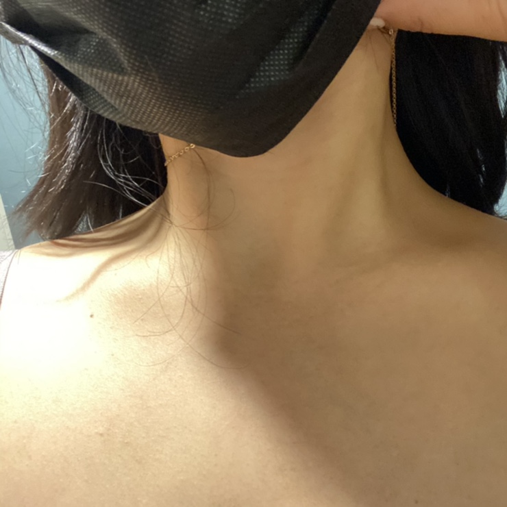  여의도 피부과에서 받은 목주름레이저와 목주름필러 [목주름시술후기] 목주름 뽀개기