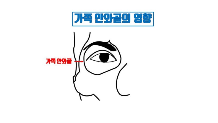  쌍꺼풀 길게 만들려고 절개 넣어도 흉터만 남고 절대 길어 지지 않아요!!!