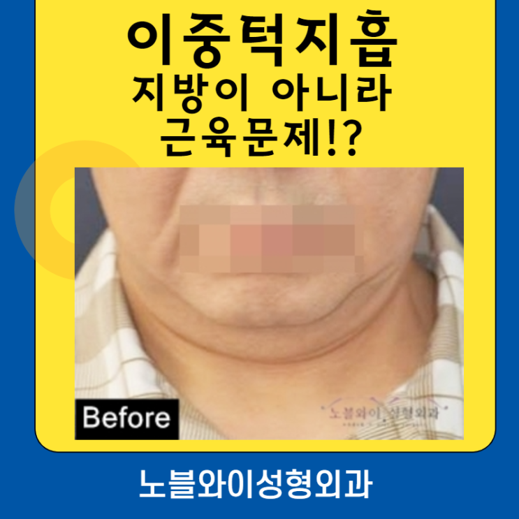  이중턱지흡 지방이 아니라 근육문제