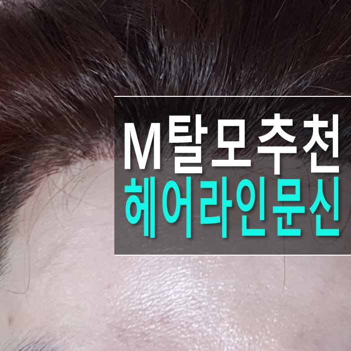  강남 반영구 헤어라인문신 남자 M탈모 대안으로 대만족