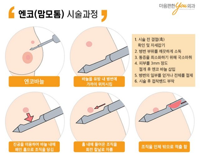 유방섬유선종보험, 위용종제거보험, 위암 병력이 있는 환자의 보험은 왜 중요한가요?