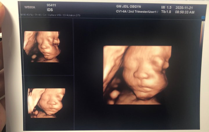 [임신일기] 임신 28주 배크기 배뭉침 증상 정리 입체초음파 비용 + 백일해 주사 클리어