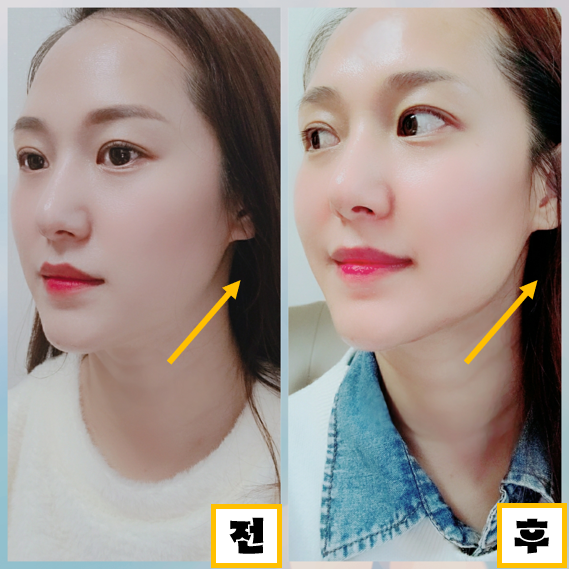  피부레이저 전문병원 추천 잠실새내 피부과