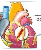 협심증 증상 및 전조증상, 치료 방법, 합병증