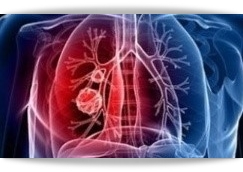 폐암 초기증상 및 치료 방법, 생존율