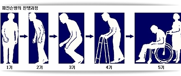  파킨슨병 초기증상 및 원인, 치료 방법, 합병증 및 예방