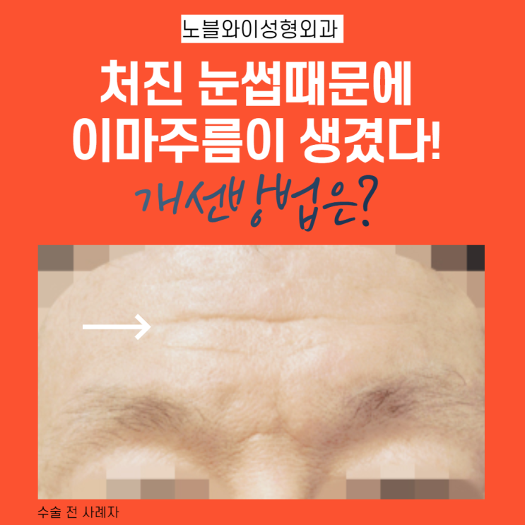  엔도타인 말고 내시경이마눈썹거상술 탈모 걱정 NO