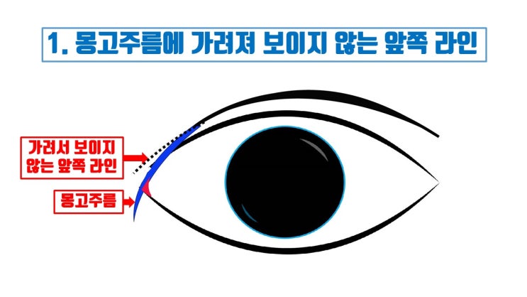  쌍수 절개 후 쌍꺼풀 앞라인이 안 잡히는 이유 Top 3