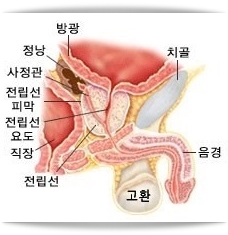 전립선비대증 증상 및 치료방법, 합병증