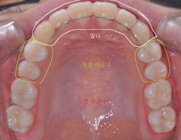 치아 신경치료 기간, 치과 신경치료 횟수(과정)