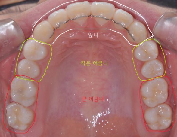  치아 신경치료 기간, 치과 신경치료 횟수(과정)