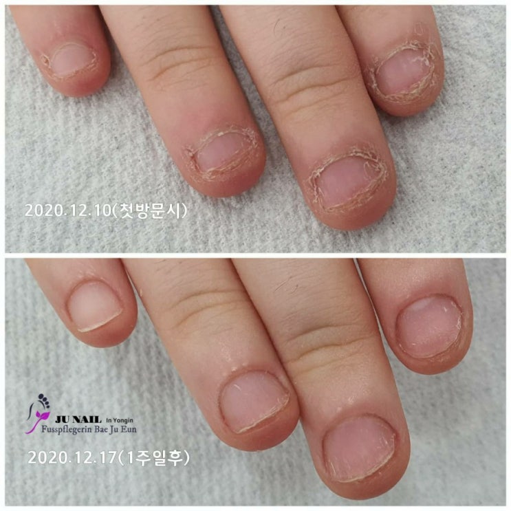 물어뜯는손톱관리 1주일후/분당용인수원수지보정동백죽전동/주네일/무좀파고드는내향성발톱손톱변형전문네일살롱 물어뜯는손톱관리 1주일후/분당용인수원수지보정동백죽전동/주네일/무좀파고드는내향성발톱손톱변형전문네일살롱