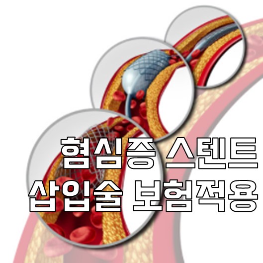  협심증 스텐트 삽입술 수술비 되나요?