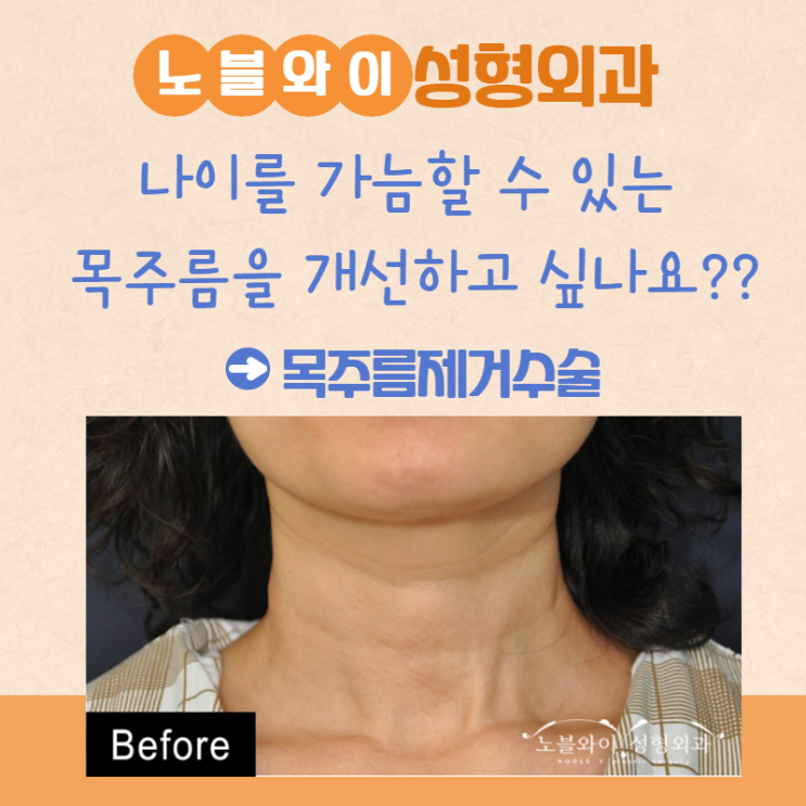  목주름제거수술 유지기간 긴 이유는