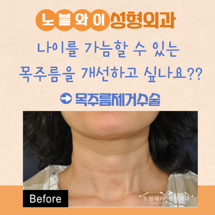 목주름제거수술 유지기간 긴 이유는