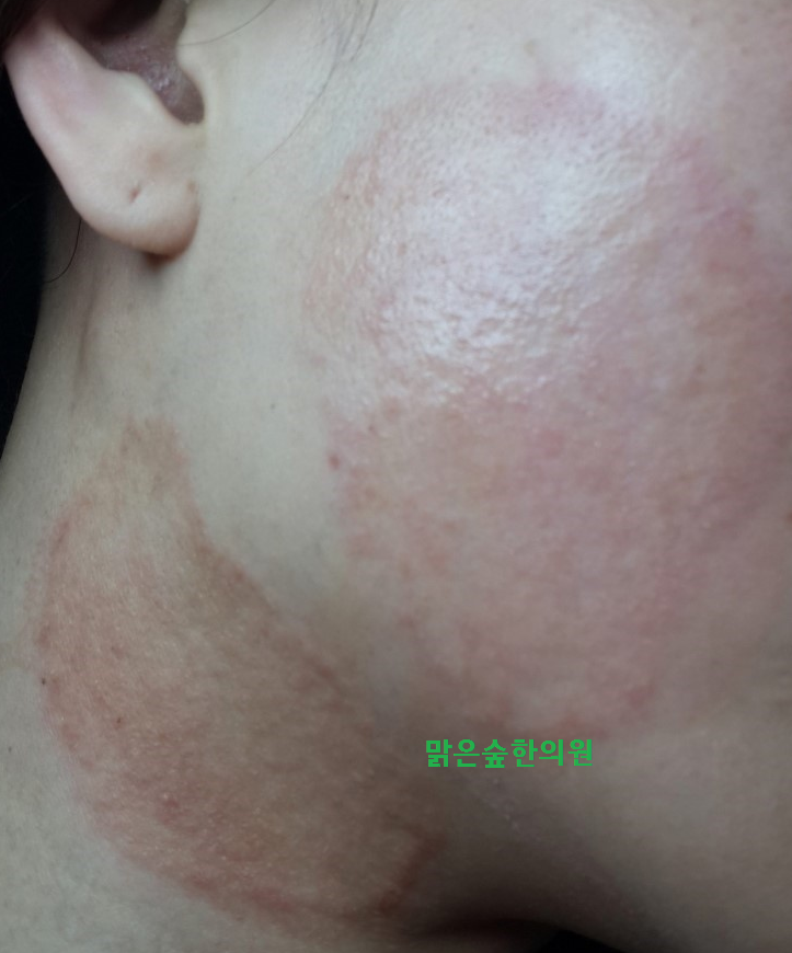 가려워서 너무힘든 체부백선, 두피백선, 완선(사타구니 백선), 무좀 - 극심한 가려움 : 네이버 블로그