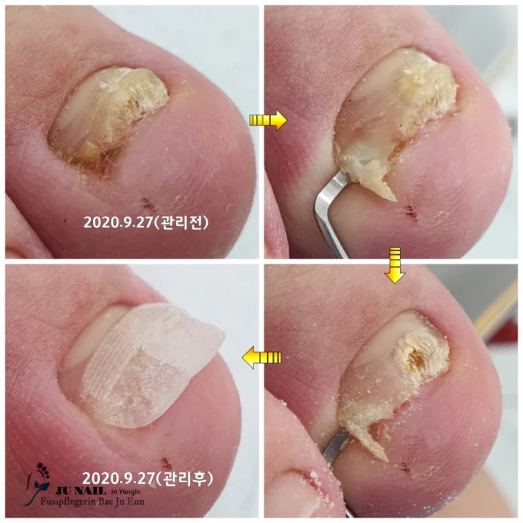 파고드는발톱이 심해져 염증때문에 걸을수가 없이 아파요./분당용인수원수지보정동백죽전동/주네일/무좀파고드는내향성발톱손톱변형전문네일살롱 파고드는발톱이 심해져 염증때문에 걸을수가 없이 아파요./분당용인수원수지보정동백죽전동/주네일/무좀파고드는내향성발톱손톱변형전문네일살롱
