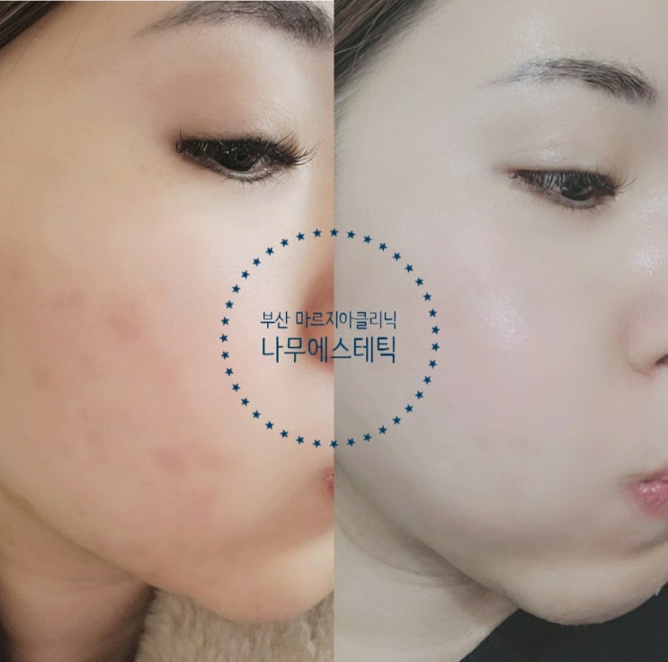  부산 마르지아클리닉 나무에스테틱 후기