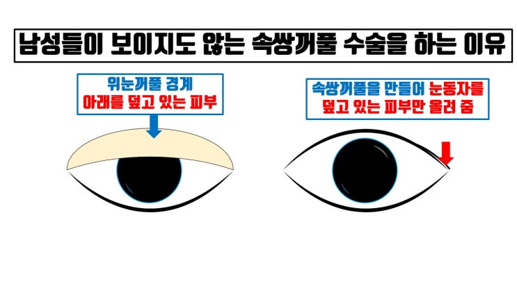  남자 쌍수 보이지도 않는데 무쌍, 속쌍으로 하는 이유는?