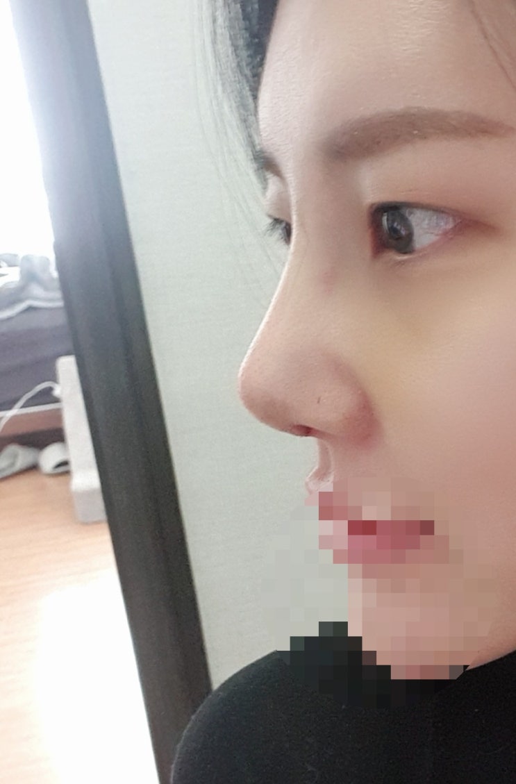  코수술 2~7일차  솜지옥 첫경험  #복코수술#코수술후기