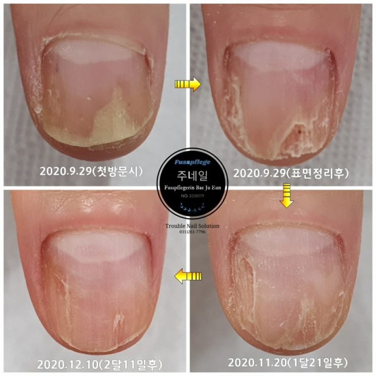 손톱조갑박리증으로 스트레스가 심하셔서 용인주네일 찾아주셨어요./분당용인수원수지보정동백죽전동/주네일/무좀파고드는내향성발톱손톱변형전문네일살롱 손톱조갑박리증으로 스트레스가 심하셔서 용인주네일 찾아주셨어요./분당용인수원수지보정동백죽전동/주네일/무좀파고드는내향성발톱손톱변형전문네일살롱