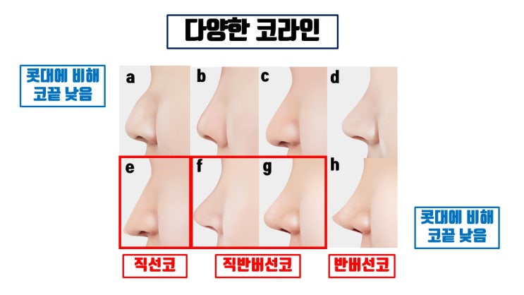  대표적인 코수술 옆모습 라인 3가지 : 직선코, 직반버선코, 반버선코