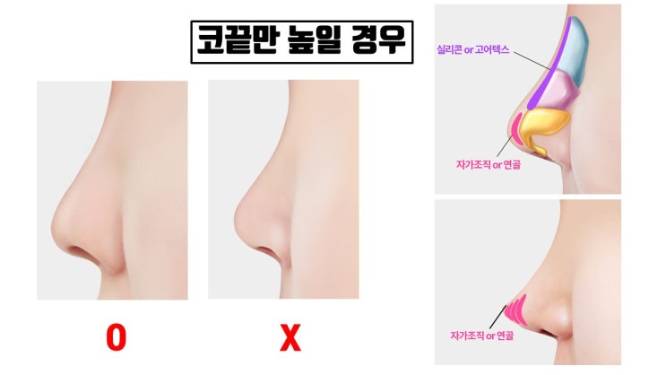  코수술 시 웬만하면 콧대만 수술, 코끝만 수술하지 마세요!!!