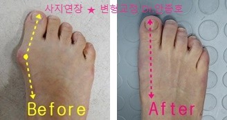  개인마다 다른 무지외반증 치료의 올바른 선택