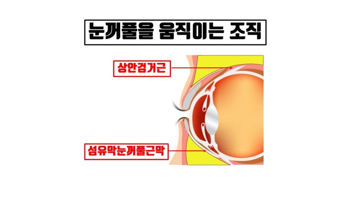  하안검성형에는 왜 안검하수 눈매교정과 같은 눈을 뜨게 해 주는 근육 교정 수술이 없나?