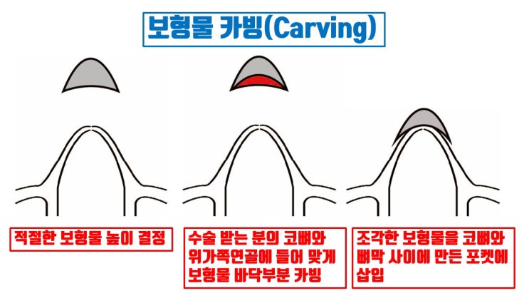  코실리콘 3mm 넣었다고 하는데 3mm 코성형보형물  삽입 되었을까?