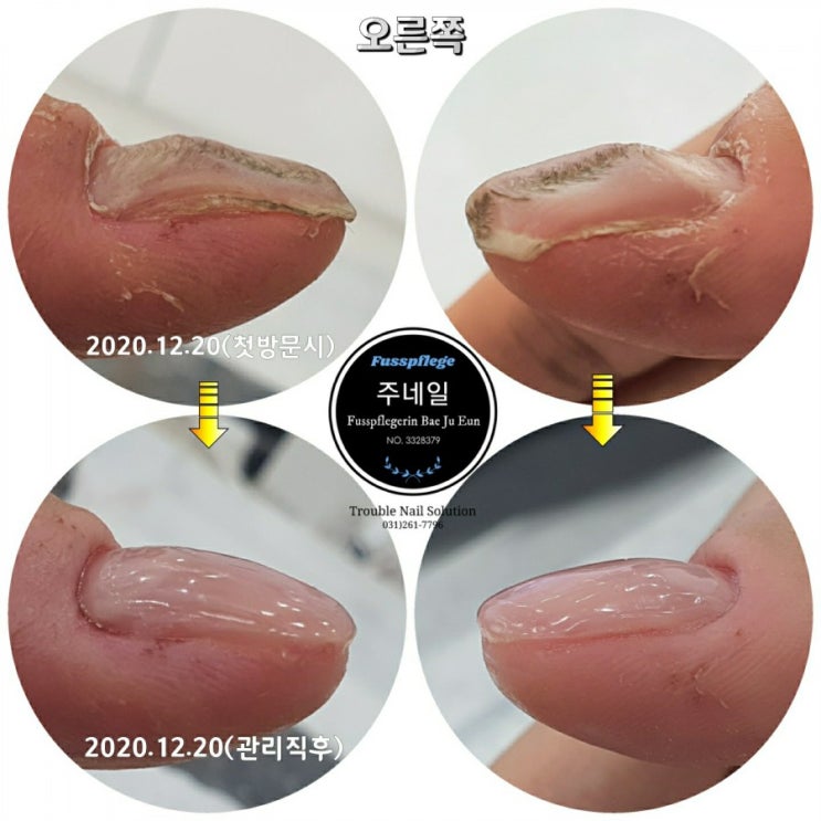 손톱이 울퉁불통(빨래판손톱).. 물어뜯던 습관때문에 이렇게 까지 손톱이 변형될지 몰랐어요./분당용인수원수지보정동백죽전동/주네일/무좀파고드는내향성발톱손톱변형전문네일살롱