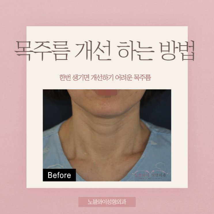 목거상술비용 유지기간 길어서 안아까워
