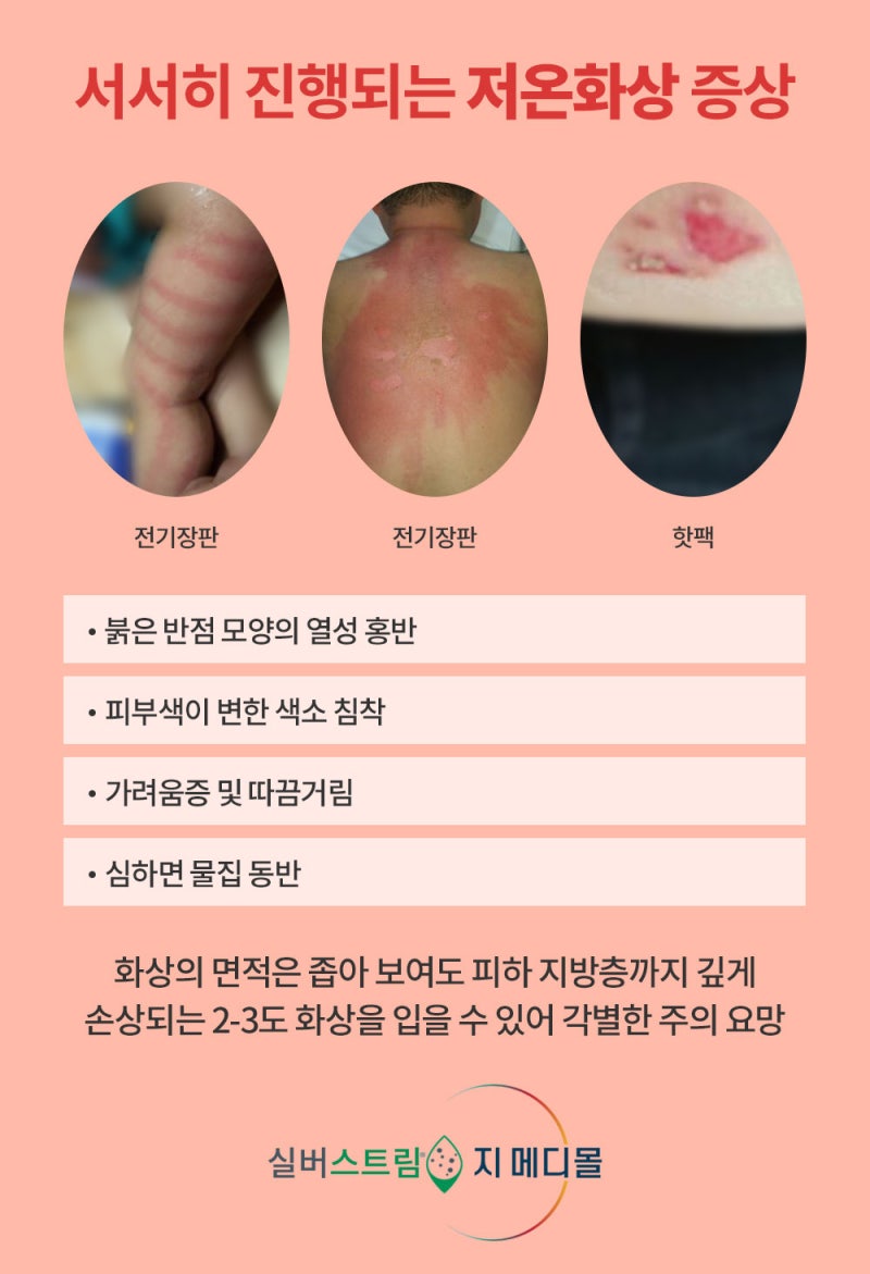 저온2도, 3도화상 응급처치 - 전기장판 화상 매년 300건 : 네이버 블로그