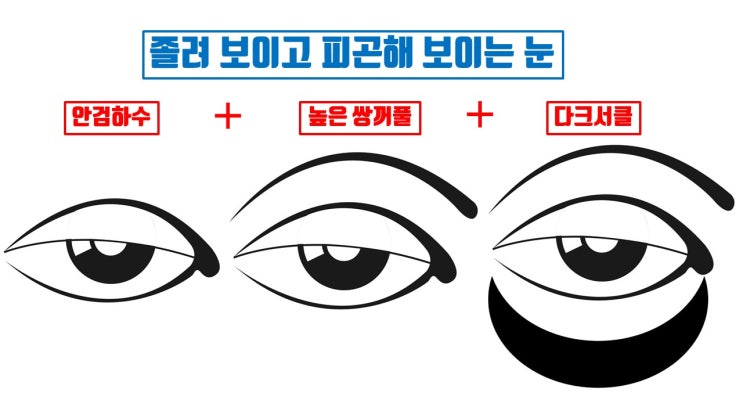  졸려 보이는 눈, 졸려 보이는 쌍꺼풀, 졸려 보이는 눈매                      3단 콤보 눈성형으로 해결 가능!!!