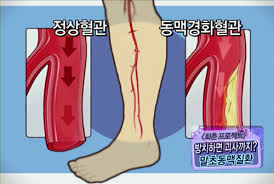  말초동맥질병정리 폐색파행증혈전염 레이노병 원인증상치료 약물수술간호 혈관질환공부