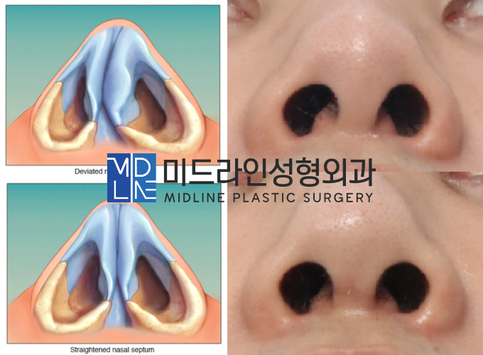 비염코수술 방법 중 비중격만곡증수술에 관하여 성형외과 전문의가 알려드립니다. (feat. Swing-door 법)