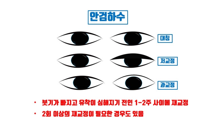  눈매교정은 과교정, 저교정으로 재교정을 반드시 받아야 한다던데…