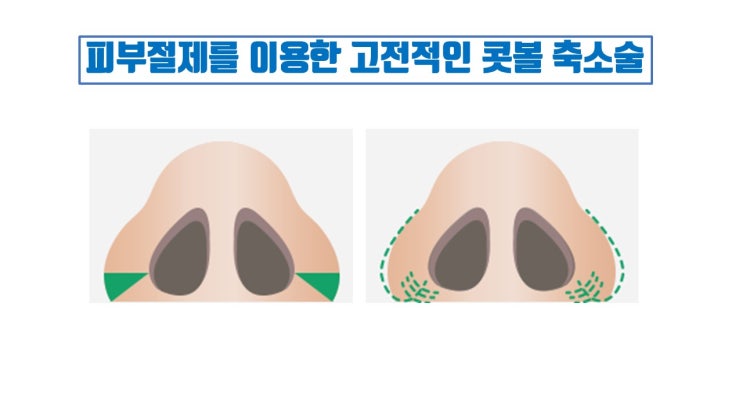  비절개콧볼축소, 내측절개콧볼축소, 무흉영구콧볼축소 절대로 무흉, 영구적이지 않아요!!!