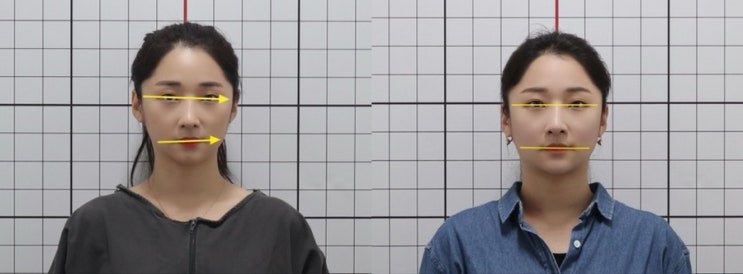  안면비대칭교정/얼굴비대칭교정 강남고터한의원에서  받은 10회 최종 후기