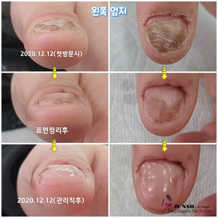 컴플렉스로 자신감까지 떨어뜨리는 울퉁불통 빨래판손톱때문에 멀리 일산에서 오셨어요./분당용인수원수지보정동백죽전동/주네일/무좀파고드는내향성발톱손톱변형전문네일살롱LCN인증살롱