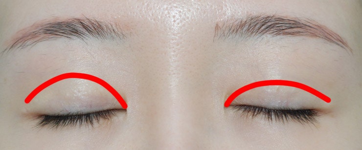 마침표성형외과_쌍꺼풀 라인 낮추기#비대칭교정 : 네이버 블로그 마침표성형외과_쌍꺼풀 라인 낮추기#비대칭교정 : 네이버 블로그