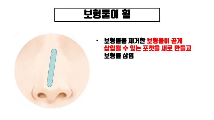 코수술 재수술을 하게 만드는 코성형 부작용 Top 5 (by 이세빈 원장의 개인 경험)
