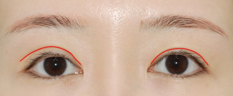 마침표성형외과_쌍꺼풀 라인 낮추기#비대칭교정 : 네이버 블로그 마침표성형외과_쌍꺼풀 라인 낮추기#비대칭교정 : 네이버 블로그