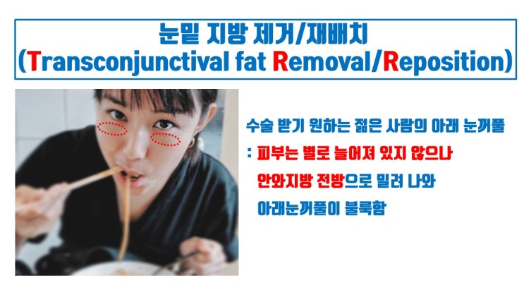  눈밑지방제거 효과 일석삼조, 눈밑지방재배치 효과 일석사조
