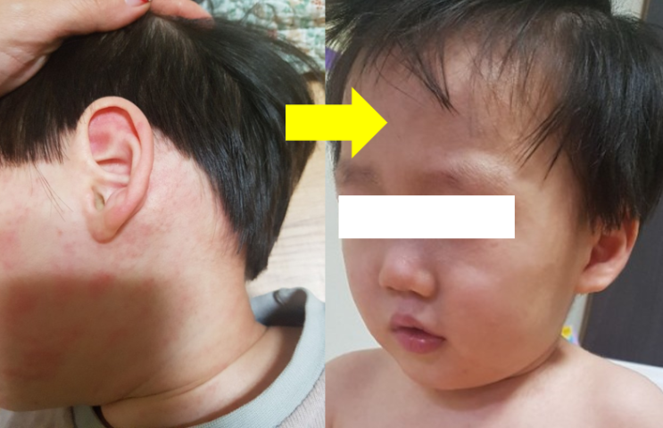  아기항생제부작용으로 두드러기(발진) 시작 후 회복