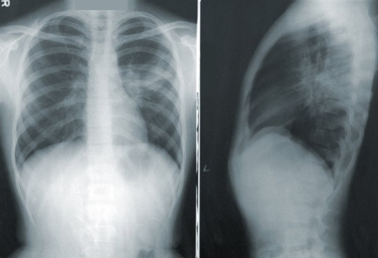 응급실 엑스레이는 정상소견이면, 타과 에스레이 검사는 "추가검사"가  아니므로 질병 사망보험금은 부책 여부