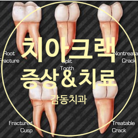  당감동치과 치아크랙 자가진단 치료방법