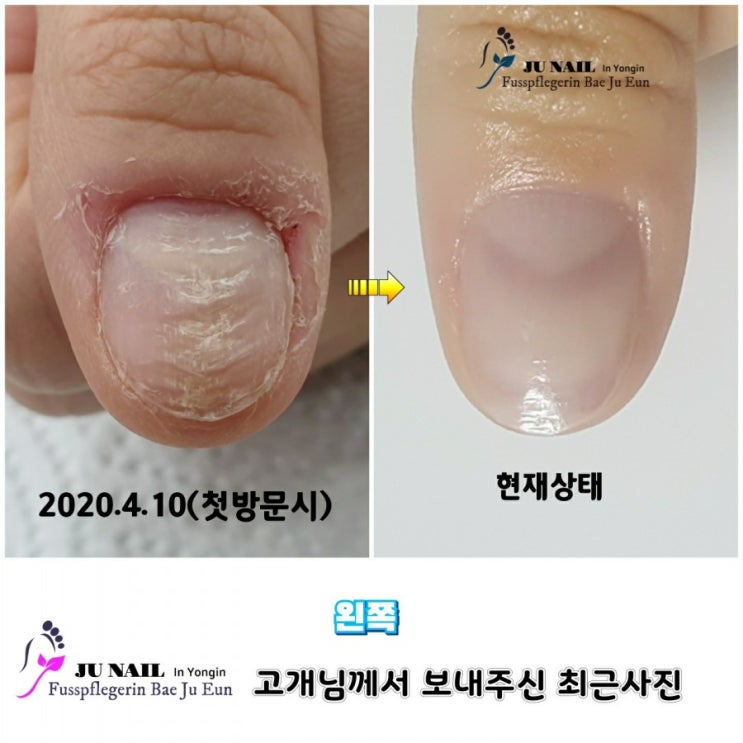 손톱이 굴곡져있고 울퉁불퉁해요. 관리후기. 1달12일 관리로 이렇게좋아졌어요./분당용인수원수지보정동백죽전동/주네일/무좀파고드는내향성발톱손톱변형전문네일살롱 손톱이 굴곡져있고 울퉁불퉁해요. 관리후기. 1달12일 관리로 이렇게좋아졌어요./분당용인수원수지보정동백죽전동/주네일/무좀파고드는내향성발톱손톱변형전문네일살롱